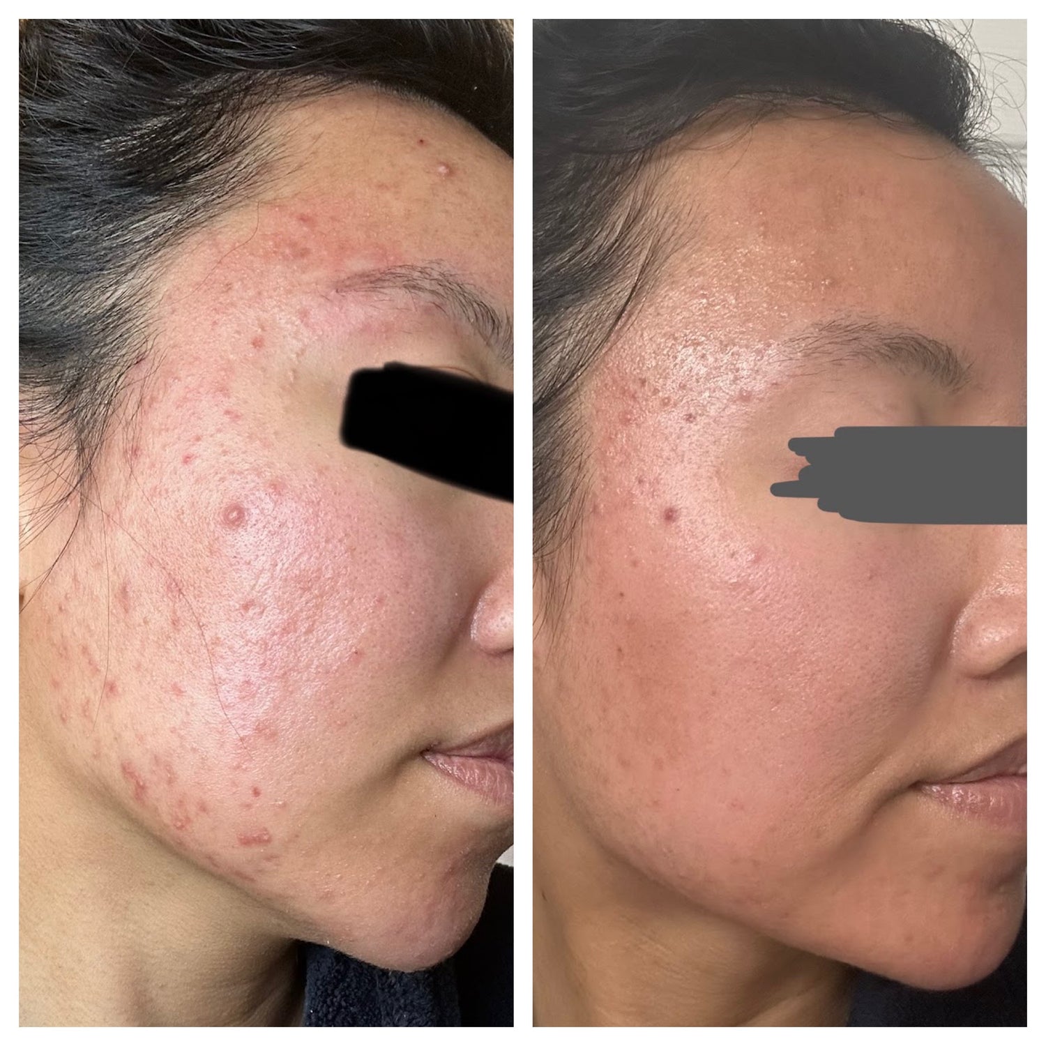 THE CLEAR SKIN SERUM