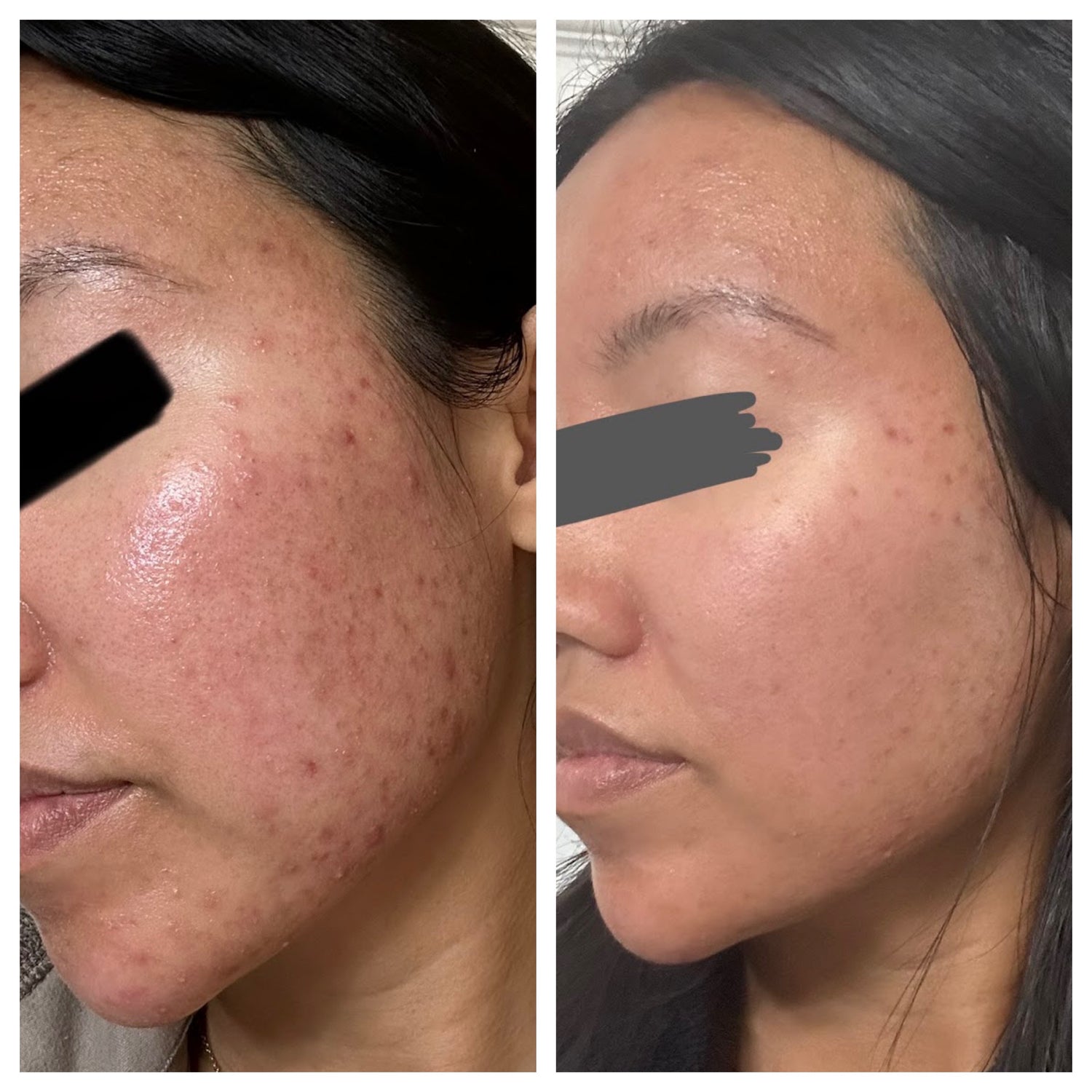 THE CLEAR SKIN SERUM