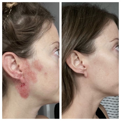 olibanum — spot treatment