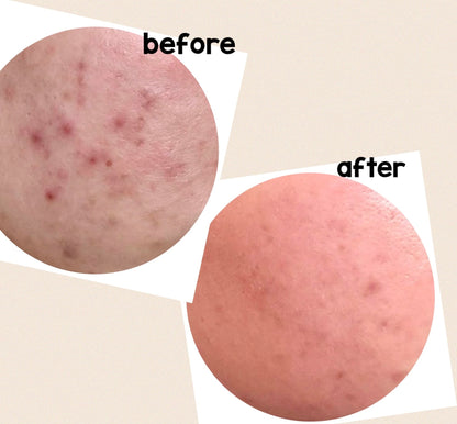 olibanum — spot treatment