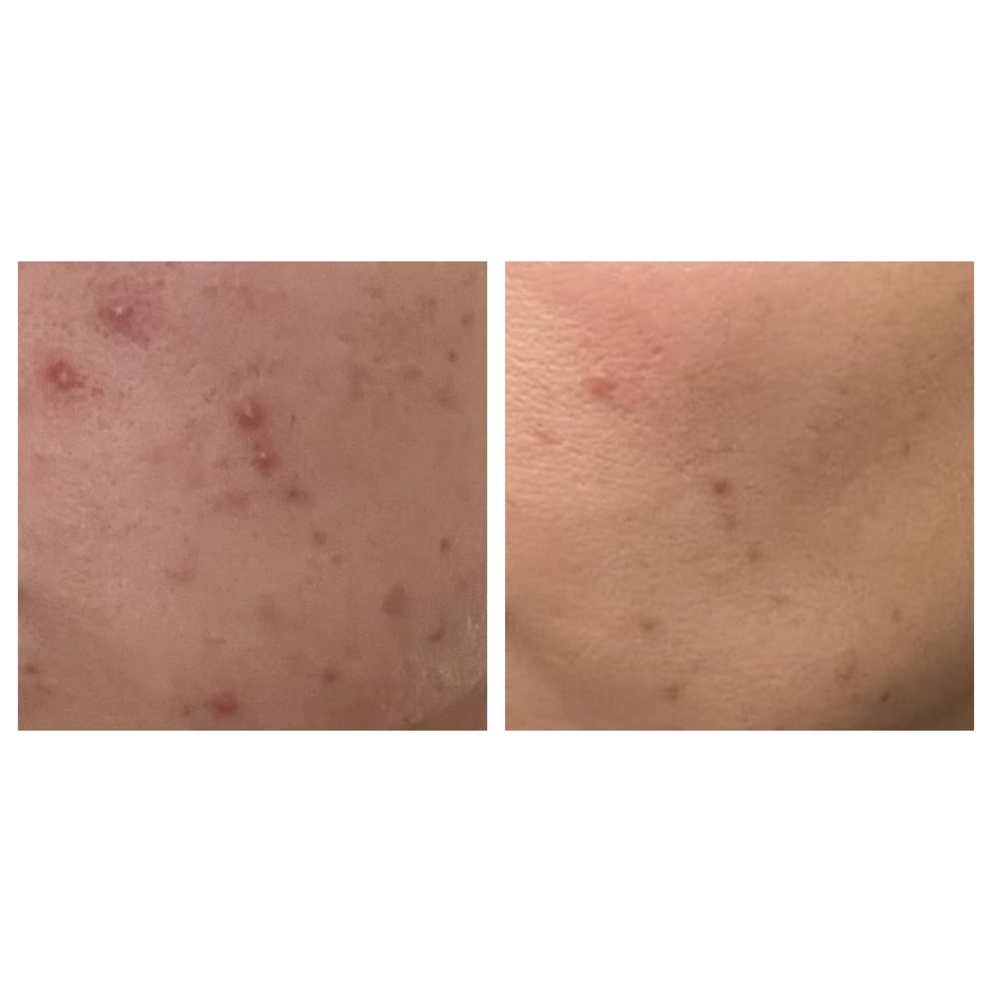 olibanum — spot treatment