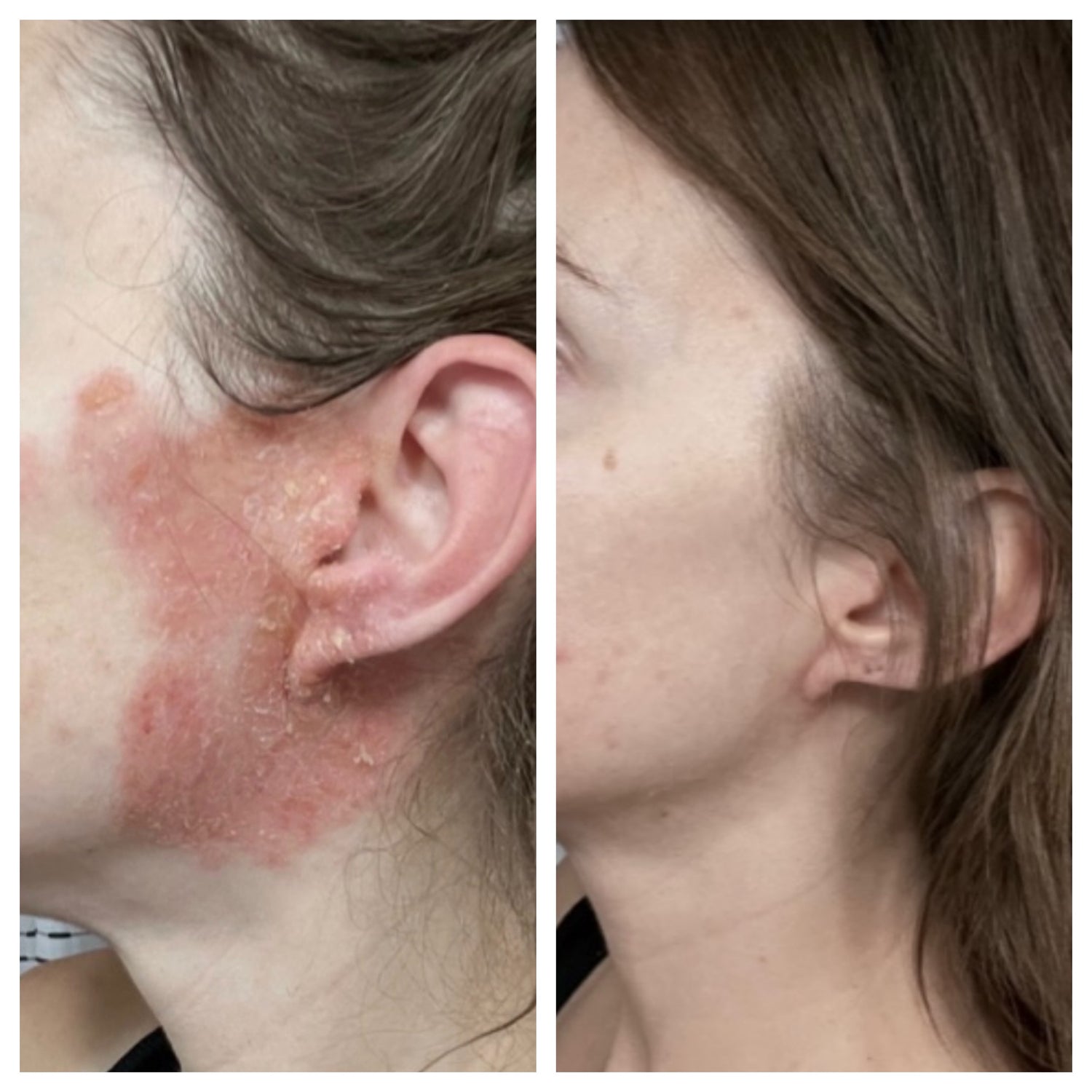 olibanum — spot treatment