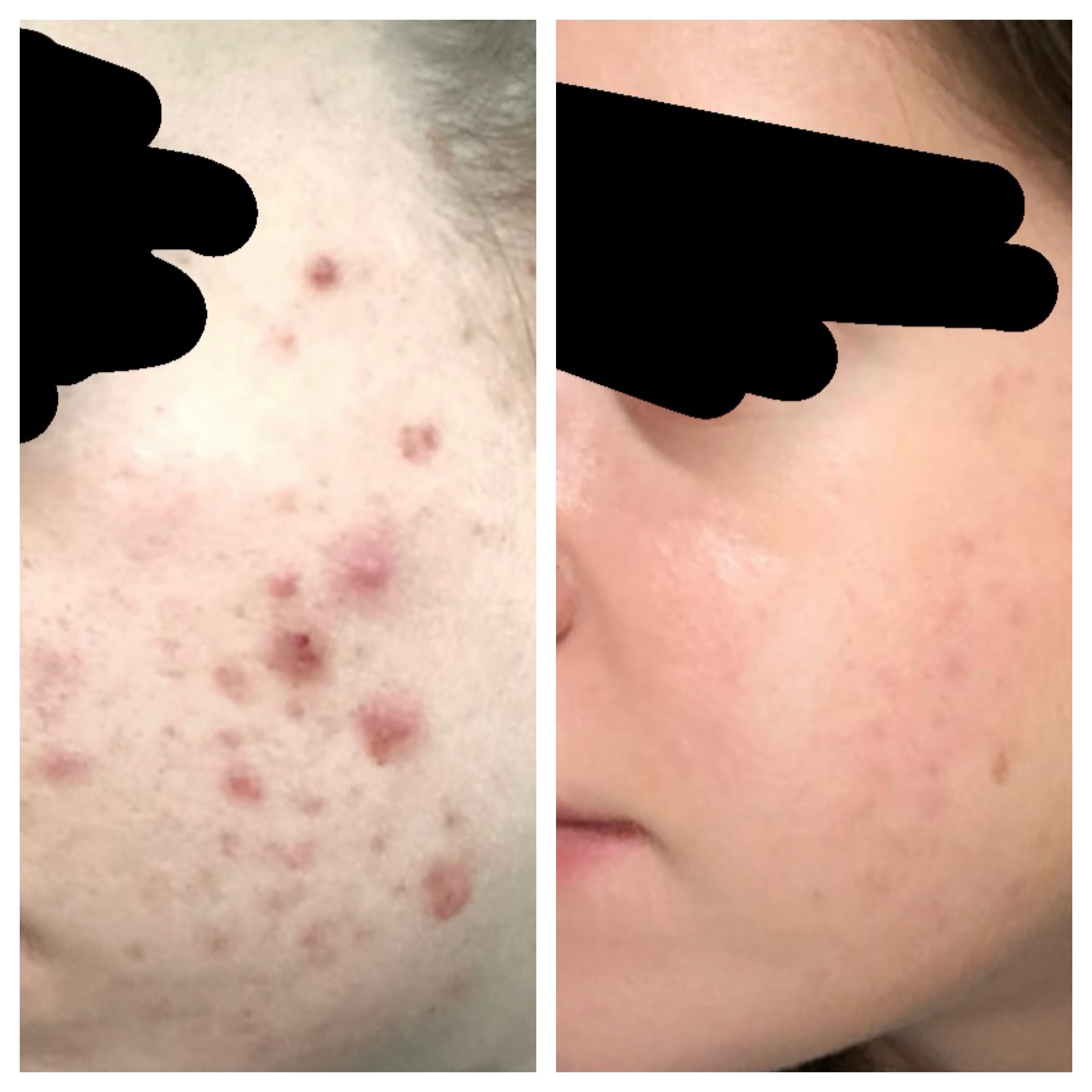 olibanum — spot treatment